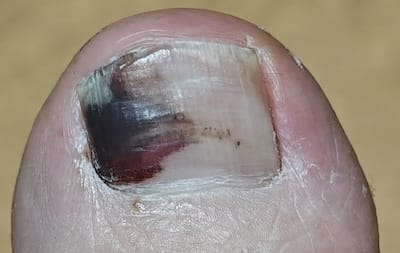 革靴で足の爪が剥がれる